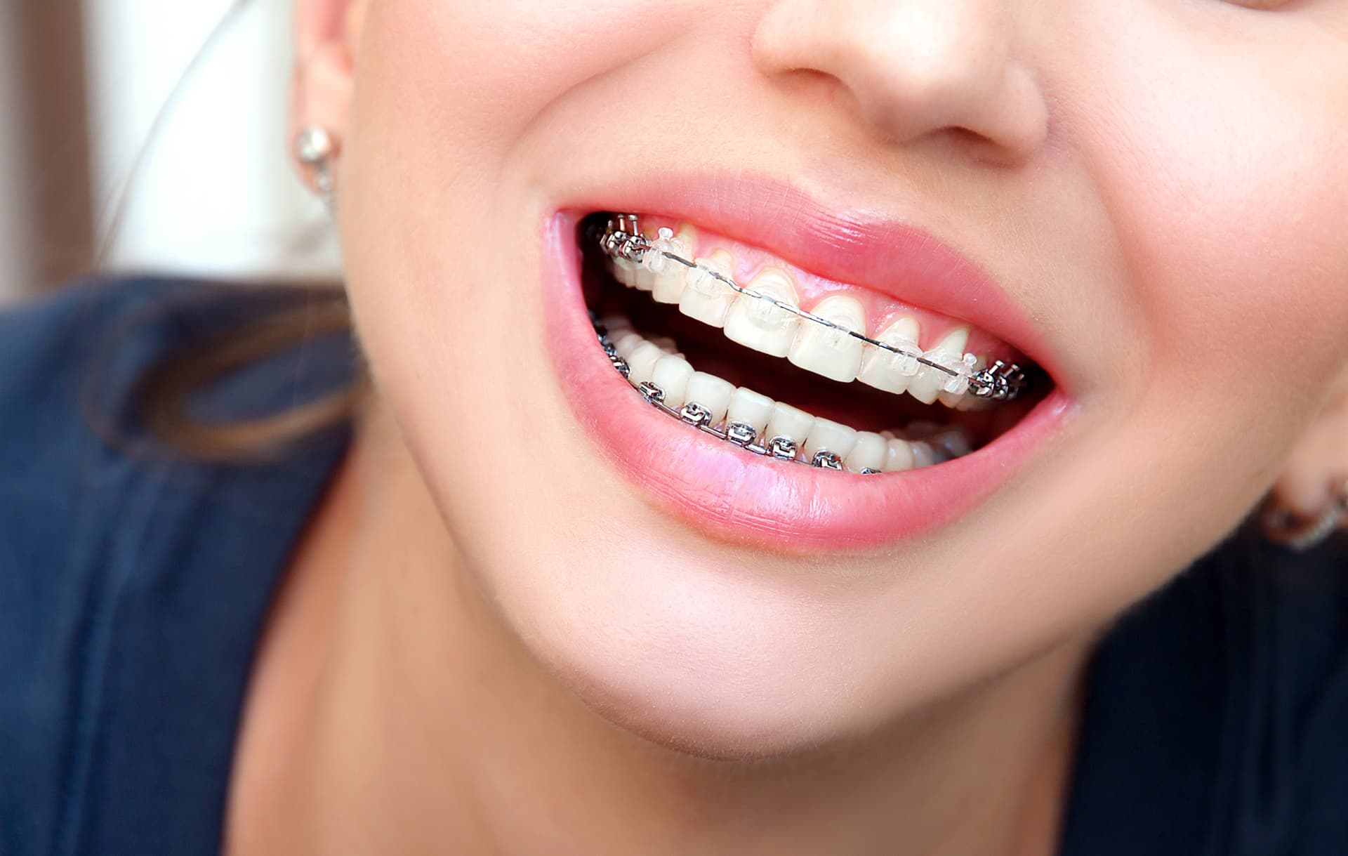  ¡Consigue una dentadura perfecta con los brackets Damon!